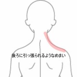 『後ろに引っ張られるめまいと右頸部の緊張で仰向けに眠れない 登別室蘭すのさき鍼灸整骨院 症例報告』の画像