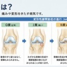 「膝が痛い」と「骨がもろい」は、実はセットで考えるべき問題でした