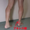 アキレス腱炎とは？