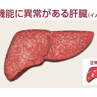 『【悲報】ワイの肝臓、逝く 	』の画像