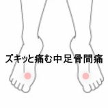 『歩行時に足指の付け根がズキッと痛む中足骨間痛　登別室蘭すのさき鍼灸整骨院　症例報告』の画像