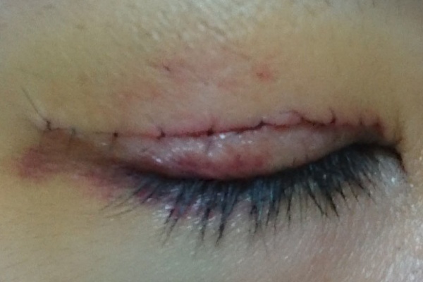 眼科医が二重まぶたの手術 切開法 を受けることになったブログ 手術