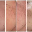 【シミ取り放題1か月後】QスイッチYAGレーザーの経過と戻りシミ｜50代主婦のリアル体験