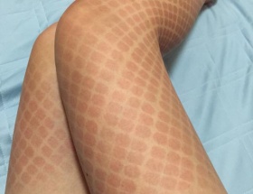 【画像あり】コミケで網タイツを履いてコスプレした女性、日焼け跡が大変なことに