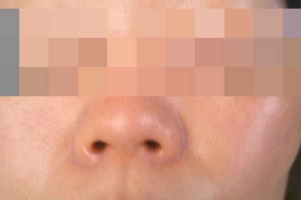 手湿疹 脱ステロイド そして角質培養 画像つき角質培養日記