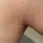 免疫力落ちた？蕁麻疹でて痒い߹-߹