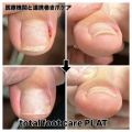 巻き爪補正症例
