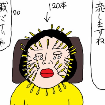 美容鍼でコスパ重視した女の末路