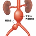 腹部大動脈瘤(りゅう)破裂で友人が突然死!そして私も!
