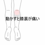 『飛行機移動後の膝裏の痛みで屈めない 　登別室蘭すのさき鍼灸整骨院　症例報告』の画像