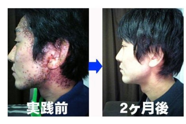 アトピー痕の肌 改善おすすめ ひどいアトピー