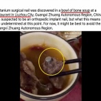 【速報】中国のスープから外科用チタン釘入りの豚骨「奇妙だな？なぜ豚にチタンの外科用釘を使うんだ？」