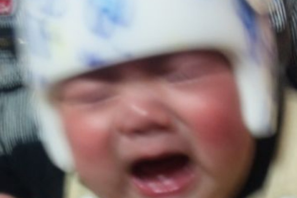 まんまるあたま 変形性斜頭症