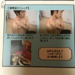 ナースの胸郭出口症候群手術と術後の経過録