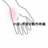 『物を持つと痛む小指と手首の痛み　登別室蘭すのさき鍼灸整骨院　症例報告』の画像