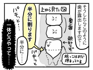 親知らずを抜こうと思っただけなのに⑥【歯茎を切って、歯を割る。】