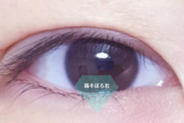 眼瞼下垂経過ブログ