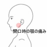 『開口時の痛みで2横指しか開かない顎関節の痛み　登別室蘭すのさき鍼灸整骨院　症例報告　』の画像