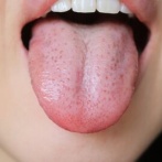 【警告】日本の若者に『舌癌』が激増 → 理由がこれらしい…