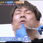 【美容整形】ヒアルロン酸注入　無意味どころか老化を加速させる害だった