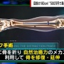 【画像】「500万円で身長10センチ伸ばせる手術」を受けた167センチ男性さん、劣等感を克服して人生が変わる　→　その手法があまりに衝撃的すぎた…