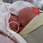 ぼちぼちゆきな【リンパ管腫（リンパ奇形種）ベビーを授かりました】