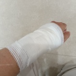 『ヤケドのケガの経過観察7※途中患部の写真もあるので閲覧にはご注意下さいませ。』の画像