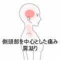 右のコメカミ頭痛と肩こり、手足の冷えを伴う症状　登別室蘭すのさき鍼灸整骨院　症例報告