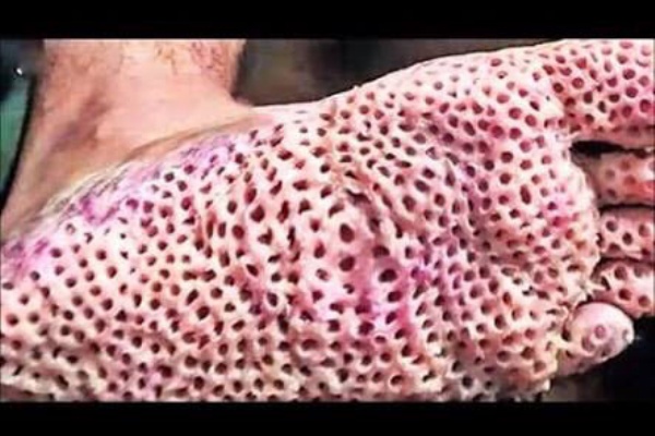 閲覧注意 足がメッシュ状になったグロ画像wwwwwww ブキミーベイベー