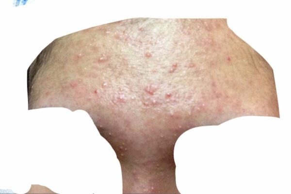 ミラクル汚肌代olのクロロフィル体験記 ニキビ