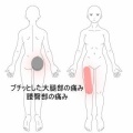 走った後の右太もも前面の痛みと歩行時の跛行 　登別室蘭すのさき鍼灸整骨院　症例報告