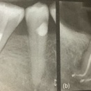根管形成　続き　その9