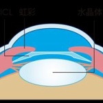 視力回復手術に70万かけた結果ぁああああ！！！