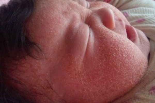 赤ちゃんもアトピーに負けない ｂｌｏｇ