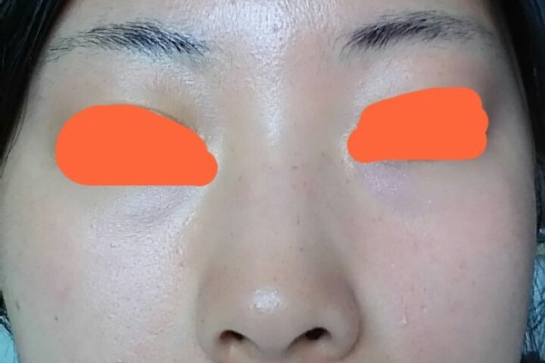 ハイドロキノンで シミを跡形もなくするまで 15