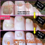 『高齢者の巻き爪・肥厚爪・白癬爪のケアに悩む方へ 』の画像