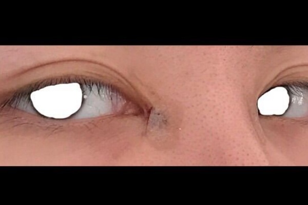 目頭切開修正 2日目 れむの目頭切開修正経過ブログ