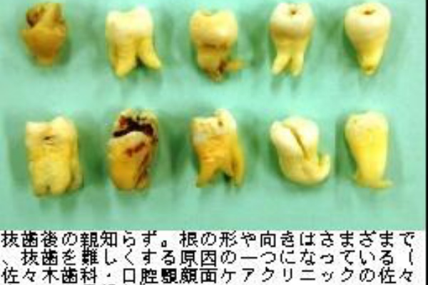 親知らず 抜歯