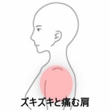 『左肩のズキズキ痛と重だるさで寝返りが打てない　登別室蘭すのさき鍼灸整骨院　症例報告』の画像