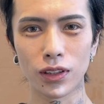 イケメンホストさん、おでこが広すぎるため整形で縮小→術後まさかの事態に・・・