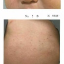 119E38     免疫性血小板減少性紫斑病（ITP）