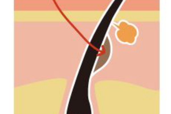 ケノンより優れた脱毛器k9 ケーナイン の実力