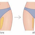 35歳からでも美尻はつくれる？本当に効く筋トレ方法って？