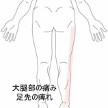 『ストレッチ後の大腿部痛としびれ感　 登別室蘭すのさき鍼灸整骨院　症例報告』の画像