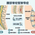 【歩くと足がしびれる・痛む】腰部脊柱管狭窄症の基本と通所リハビリでできるアプローチ