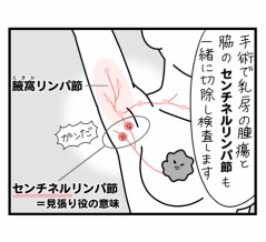 乳がん列伝「手術説明と入院準備」②