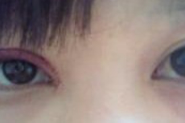 雨のち晴れ 二重 2