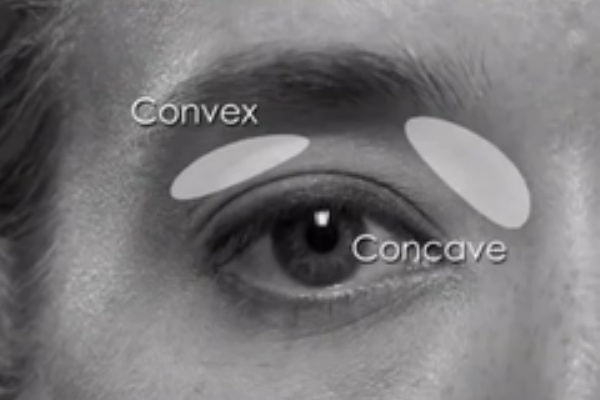 現代美容整形理論 二重切開