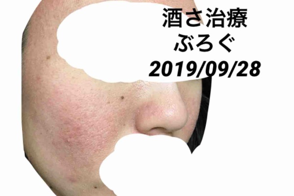 酒さ治療ぶろぐ始めました 酒さ 酒さ様皮膚炎スキンケア