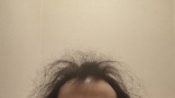 まだ32なのに頭がハゲかけててヤバいんだが（※画像あり）